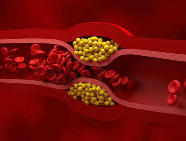 Types of Hyperlipidemia and how to manage it